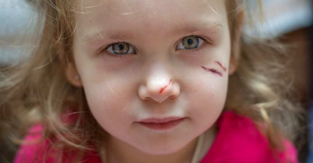child needs plastic surgery to prevent scarring
