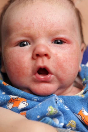 Newborn Rashes - Mommybites