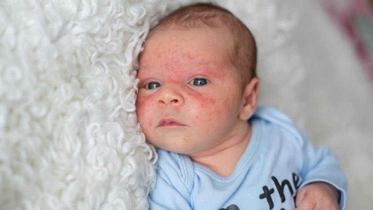 Baby Acne Treatment And Causes Mommybites
