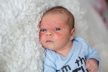 severe baby acne