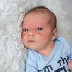 7 All-Natural Ways to Deal with Baby Eczema