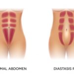 This Is How to Check for Diastasis Recti
