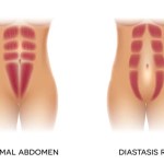 This Is How to Check for Diastasis Recti